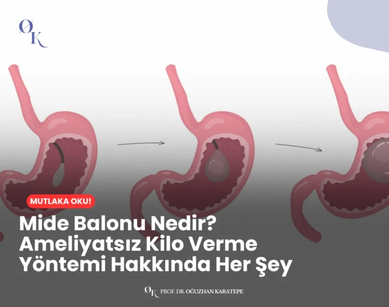 Endoskopik mide balonu uygulamasının şematik gösterimi