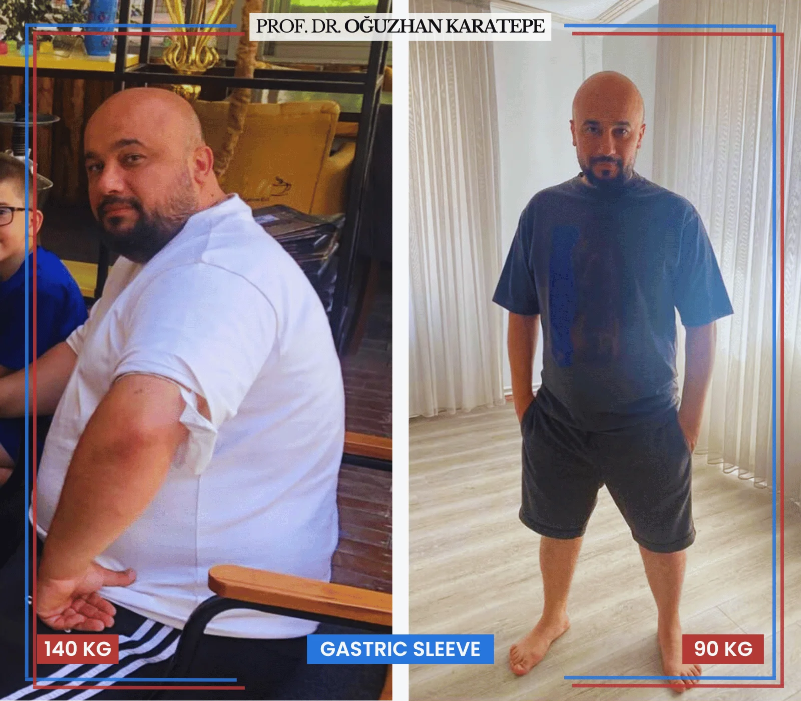 Tüp mide ameliyatı mide küçültme öncesi sonrası görsel sonuçları

