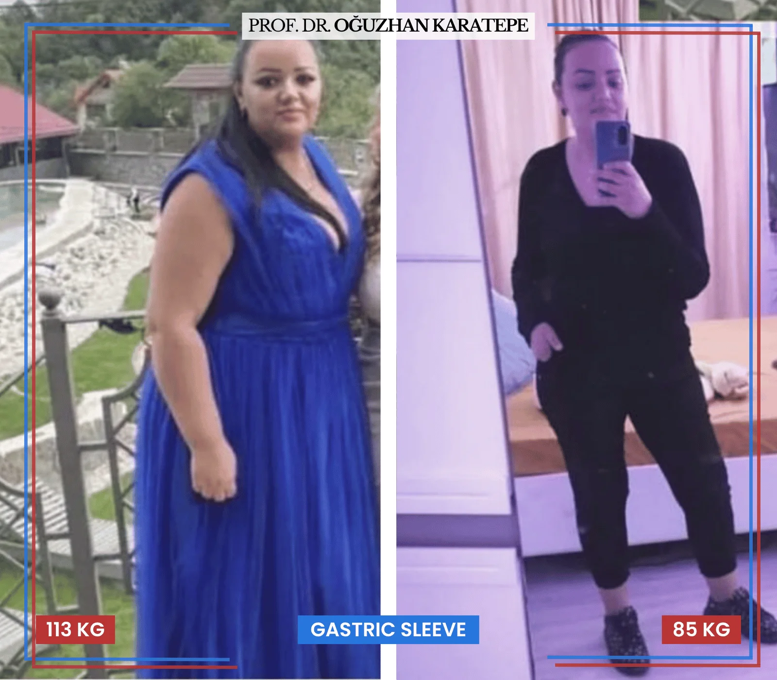 Oğuzhan Karatepe obezite ameliyatı hasta dönüşüm fotoğrafları