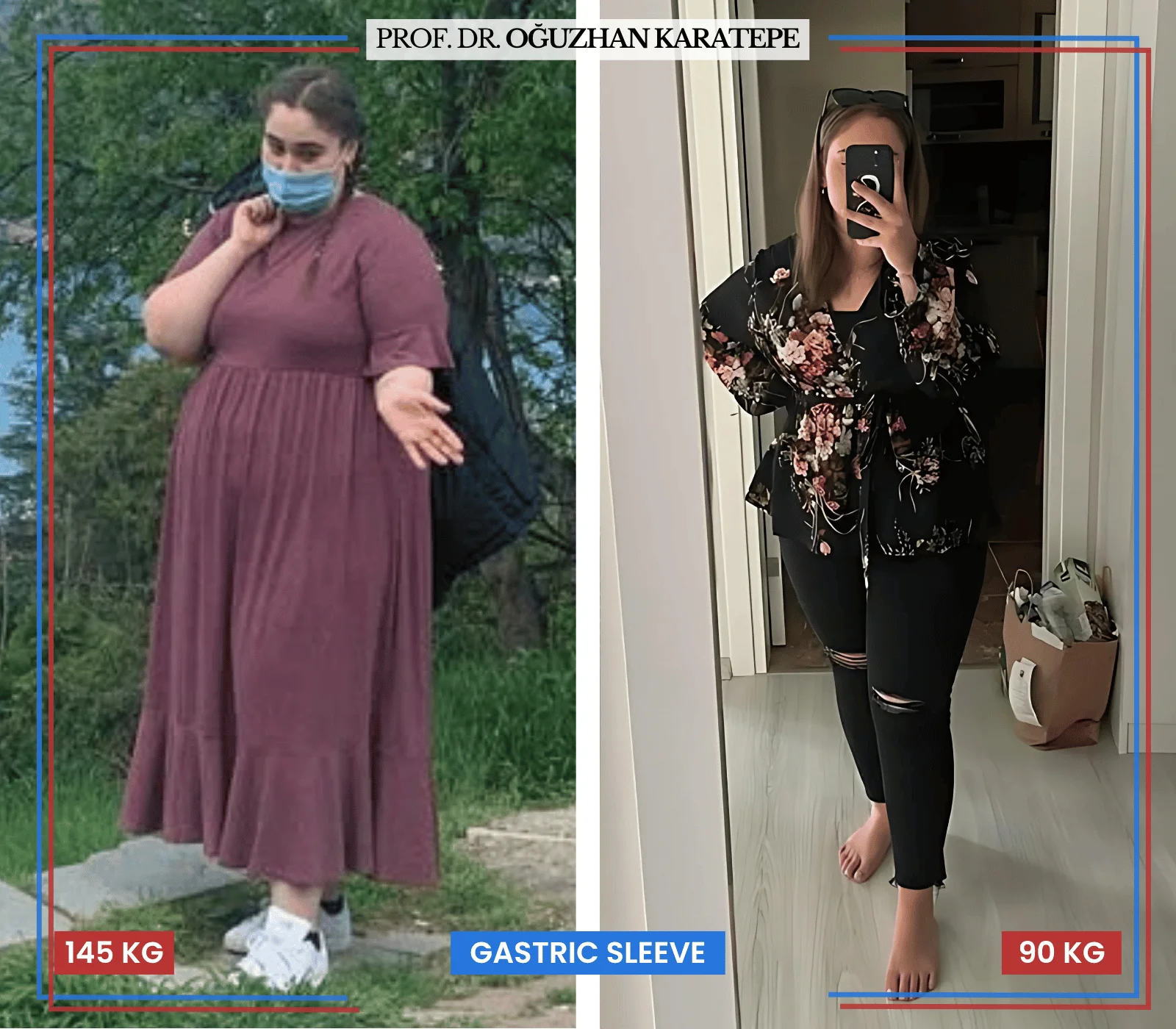 Tüp mide ameliyatı mide küçültme öncesi sonrası hasta değişim fotoğrafları