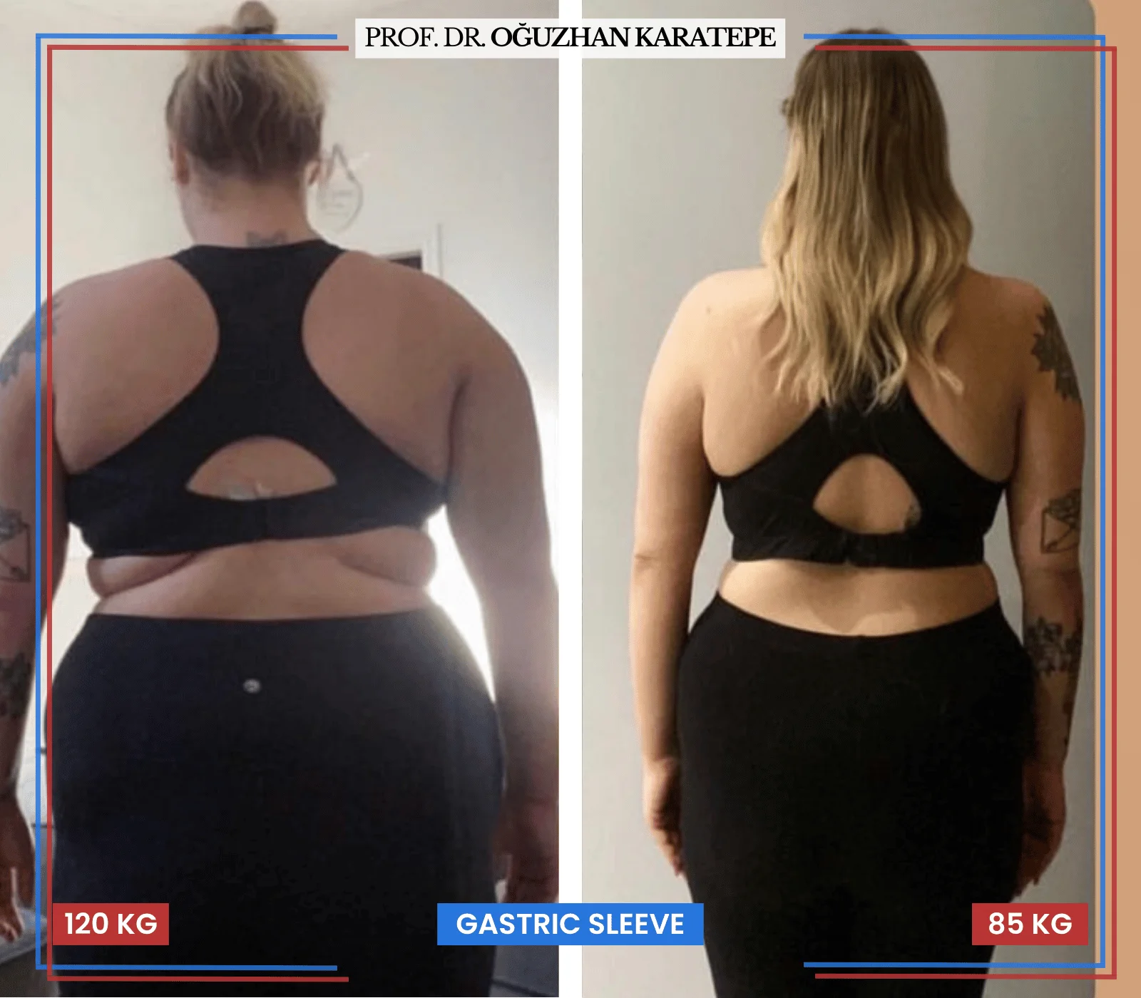 Tüp mide ameliyatı hasta dönüşüm fotoğrafı