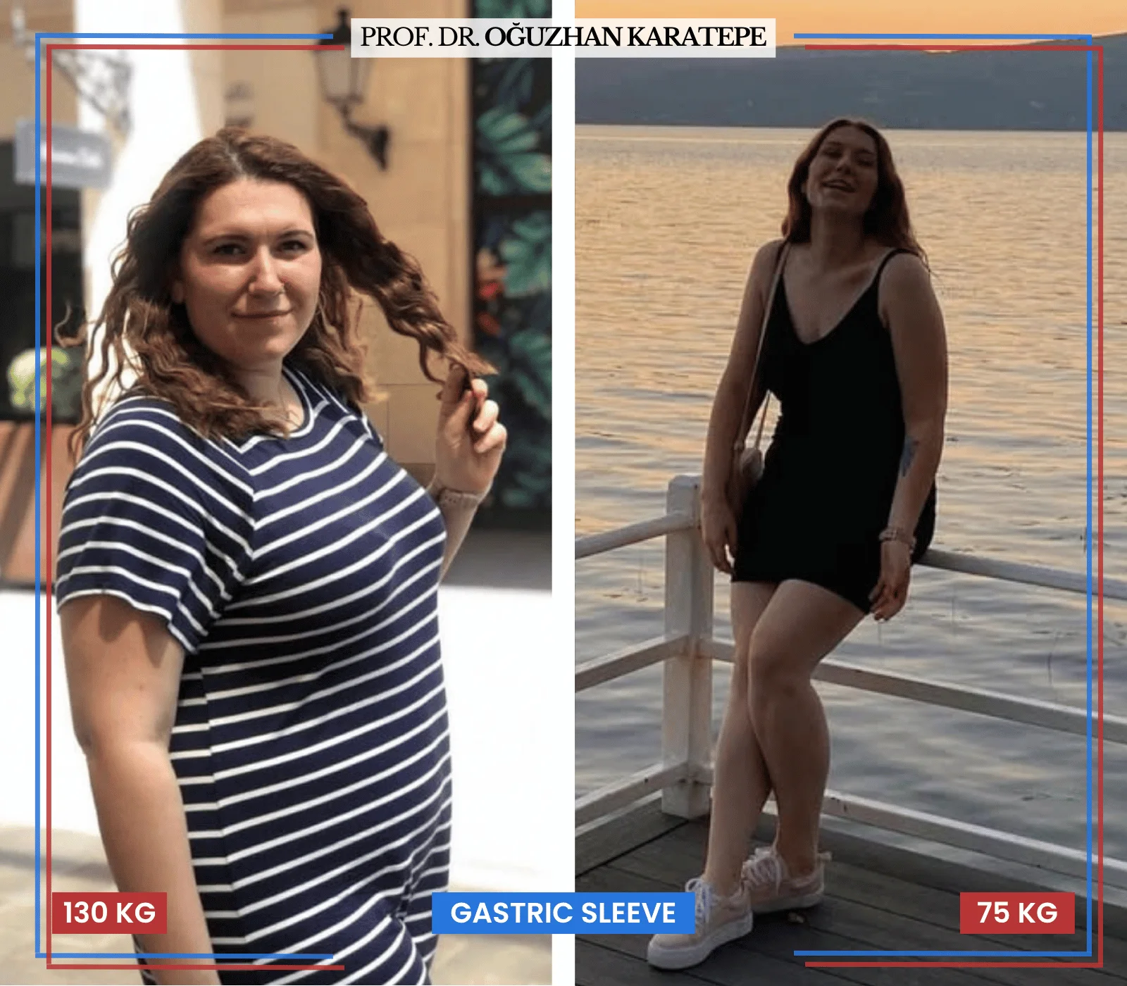 Tüp mide ameliyatı mide küçültme öncesi sonrası fotoğrafları ile kilo kaybı değişimi