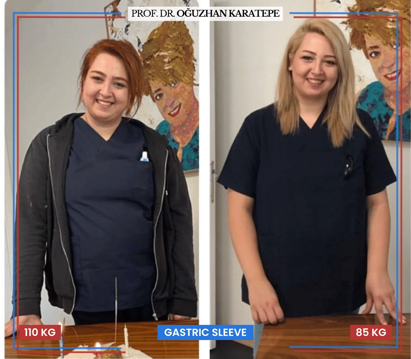 Tüp mide ameliyatı hasta dönüşüm fotoğrafı